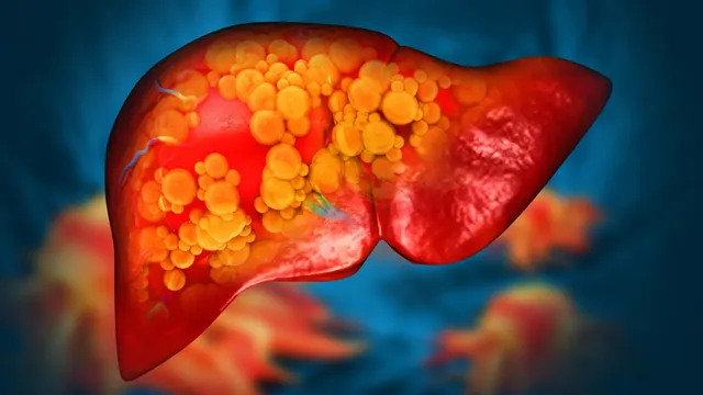 Polyethylene Microplastics Linked to Fatty Liver Disease, Diet Exacerbates Risk