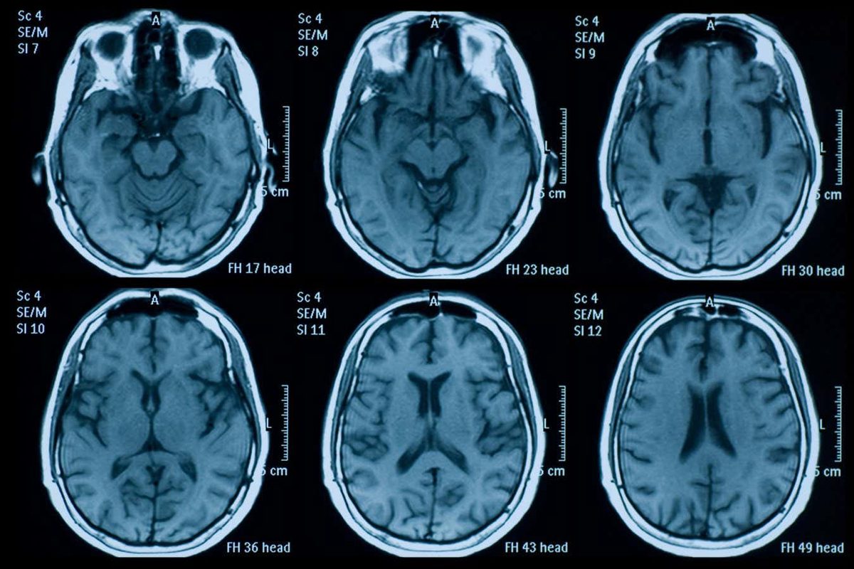 The Untold Neurological Impact of the COVID-19 Pandemic on Our Brains