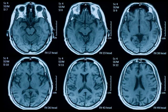 The Untold Neurological Impact of the COVID-19 Pandemic on Our Brains