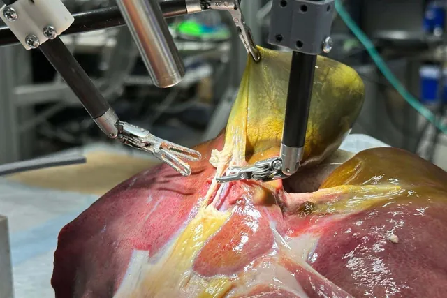Breakthrough in Surgical Robotics: AI System Performs Autonomous Gallbladder Surgery