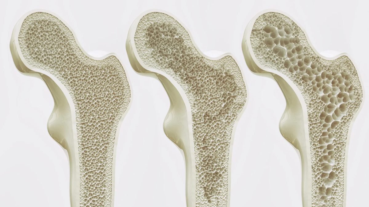 Excessive Coffee Linked to Weaker Bones in Older Women, Tea Shows Modest Benefit