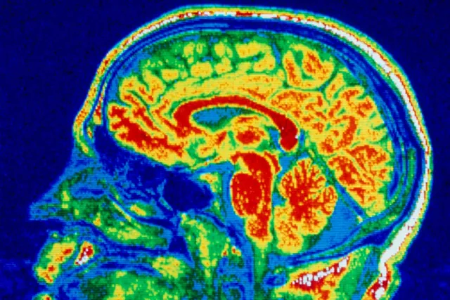 New Insights into Brain Alterations in Children with Restrictive Eating Disorders Reveal Links to OCD and Autism