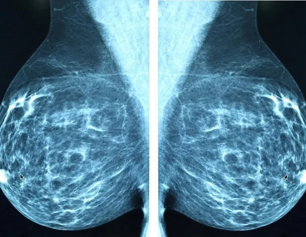 Global Breast Cancer Risk: 1 in 18 Lifetime Diagnosis, Stark Inequalities Revealed