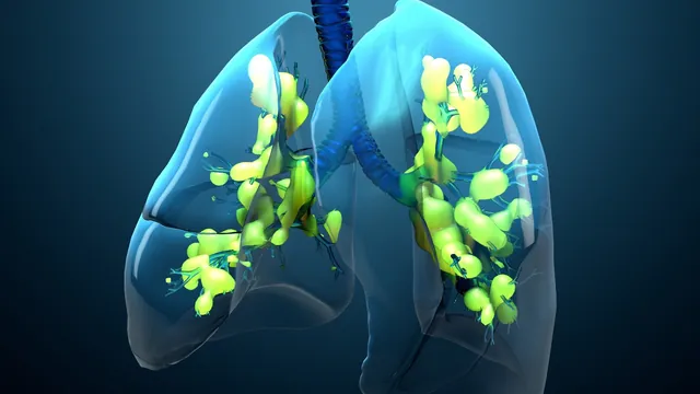 How Artificial Intelligence Is Revolutionizing Acute Respiratory Distress Syndrome Management