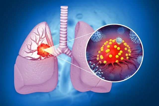 New Research Suggests Allergies May Reduce Lung Cancer Risk: A Comprehensive Meta-Analysis