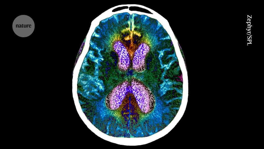 Cognitive Resilience: A New Predictor for Alzheimer's Dementia