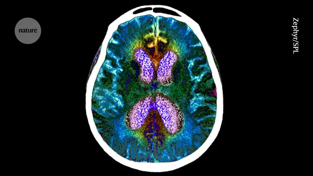 Cognitive Resilience: A New Predictor for Alzheimer's Dementia
