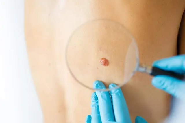 Personalized Melanoma Vaccine Shows Promise in Post-Surgery Trial