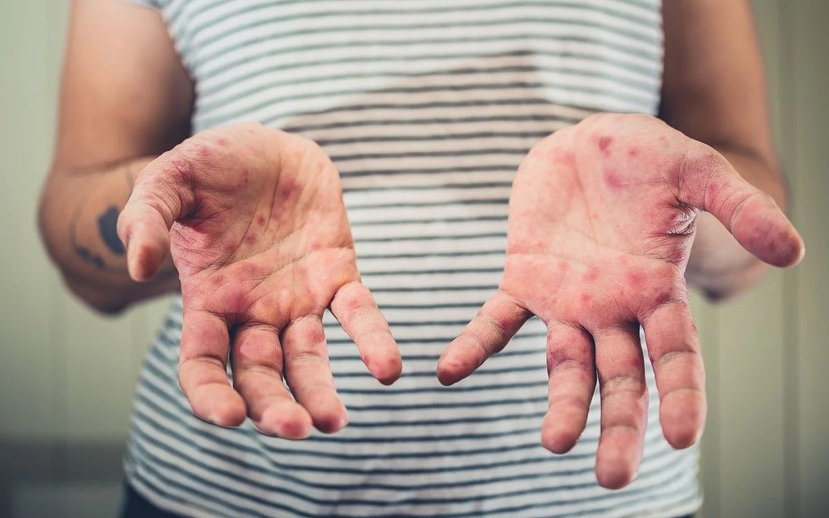 US Measles Cases Surge to 35-Year High, Fifth Death Reported in Pennsylvania