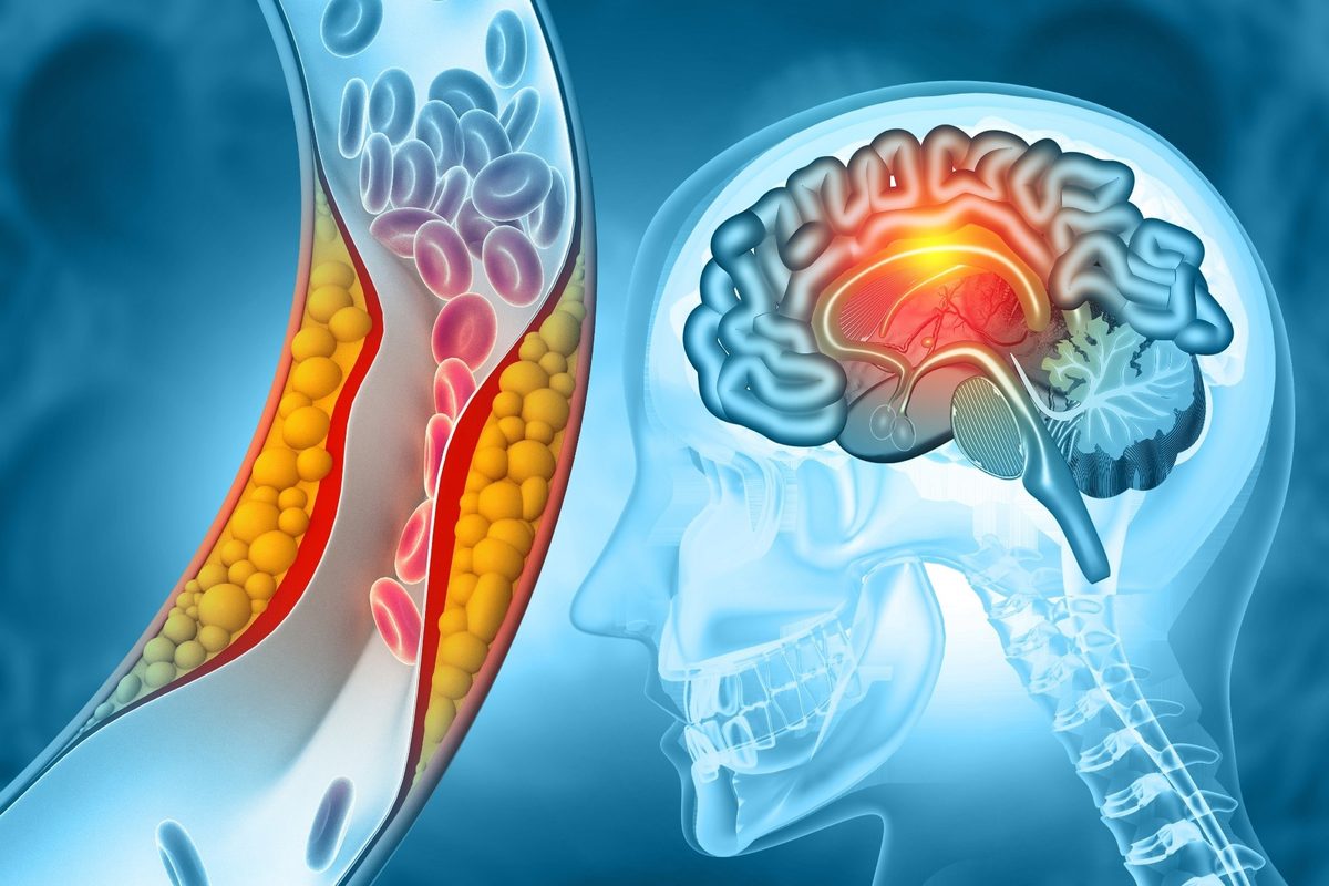 Blocking GAPDH aggregation protects brain cells and opens new path for stroke therapy
